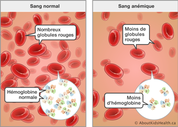 Sang avec nombreux globules rouges et hémoglobine normale et sang anémique avec moins de globules rouges et d’hémoglobine