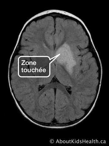 Une IRM du cerveau avec la zone touchée identifiée