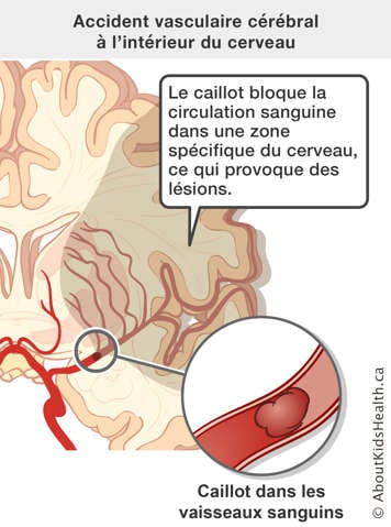 Caillot bloque la circulation sanguine dans une zone spécifique du cerveau, ce qui provoque des lésions