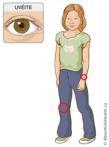 Identification des articulations des genoux et poignets d&rsquo;une fille et une illustration d&rsquo;un &oelig;il atteint de l&rsquo;uv&eacute;ite