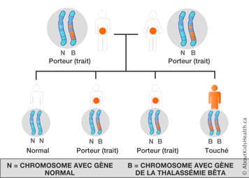 La distribution des chromosomes d’un homme et d’une femme, chacun avec un chromosome avec un gène de bêta-thalassémie