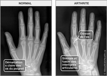 Radiographies d’une main normale et d’une main arthritique avec érosion, sténose et fusion des os et interlignes articulaires