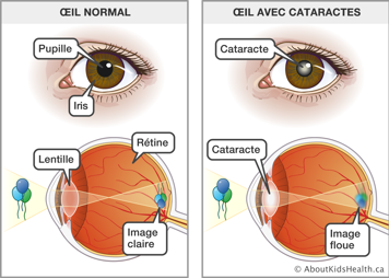 La pupille et iris d’un œil normal voyant une image claire des ballons et un œil avec cataractes voyant une image floue