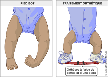 Bébé avec pied bot et bébé portant des orthèses à l’aide de bottes et d’une barre