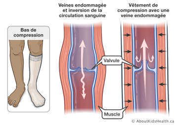 Inversion de circulation dans la veine endommagée et meilleure circulation dans veine endommagée avec vêtement de compression