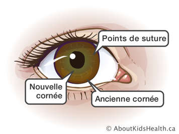 Un œil avec une nouvelle cornée attachée à l'ancienne cornée par des points de suture