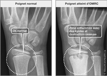 Radiographies d’un poignet normal et d’un poignet atteint d’OMRC avec zone enflammée avec des kystes et destruction osseuse