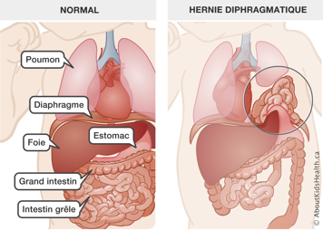 B&eacute;b&eacute; avec l&rsquo;emplacement normal des organes, compar&eacute; &agrave; un b&eacute;b&eacute; avec les organes abdominaux dans la cavit&eacute; thoracique