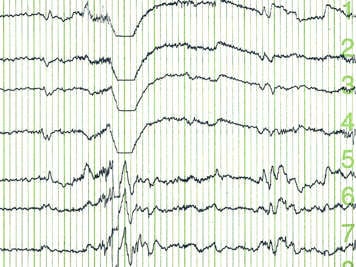 Tracés d'un électroencéphalogramme