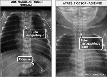 Rayon-x d’un sonde naso-gastrique normal et rayon-x d’un cas d’atrésie sophagienne