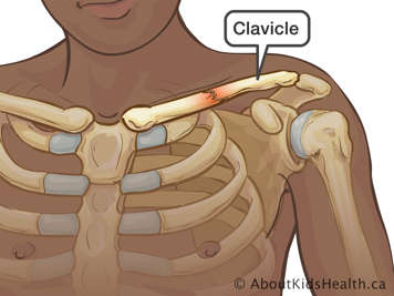 Fracture de la clavicule