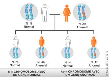 Distribution des chromosomes d’un parent normal et d’un parent portant un chromosome avec un gène anormal