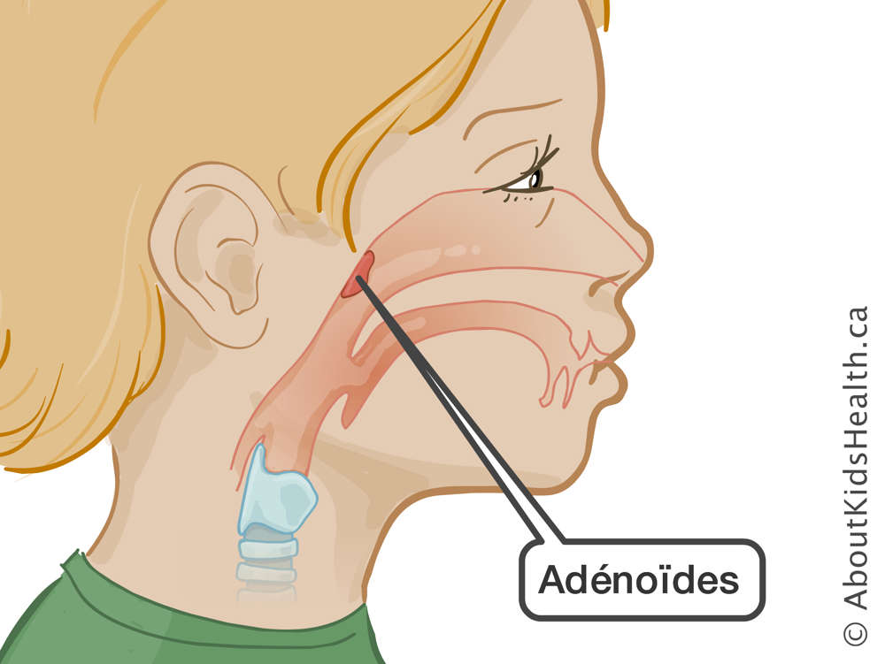 L'emplacement des adénoïdes
