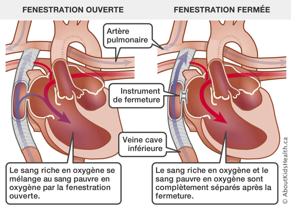 La circulation sanguine dans un cœur avec la fenestration ouverte et dans un cœur avec un instrument de fermeture
