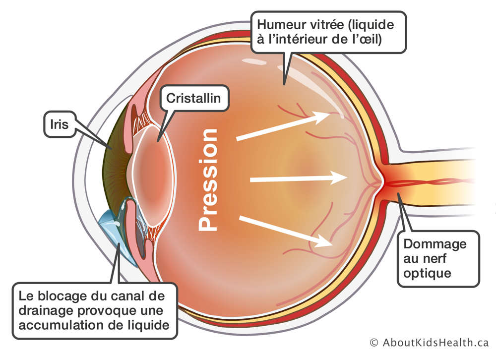 Vue intérieure du globe oculaire atteint de glaucome où l’accumulation de liquide dans la partie avant de l’œil augmente la pression sur le globe oculaire, provoquant des dommages au nerf optique