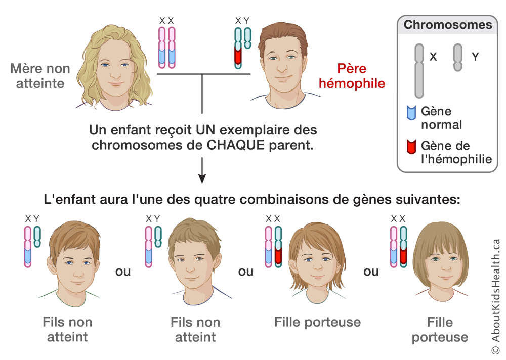 Distribution des chromosomes X et Y d’une mère non atteinte et d’un père hémophile, produisant quatre résultats possibles