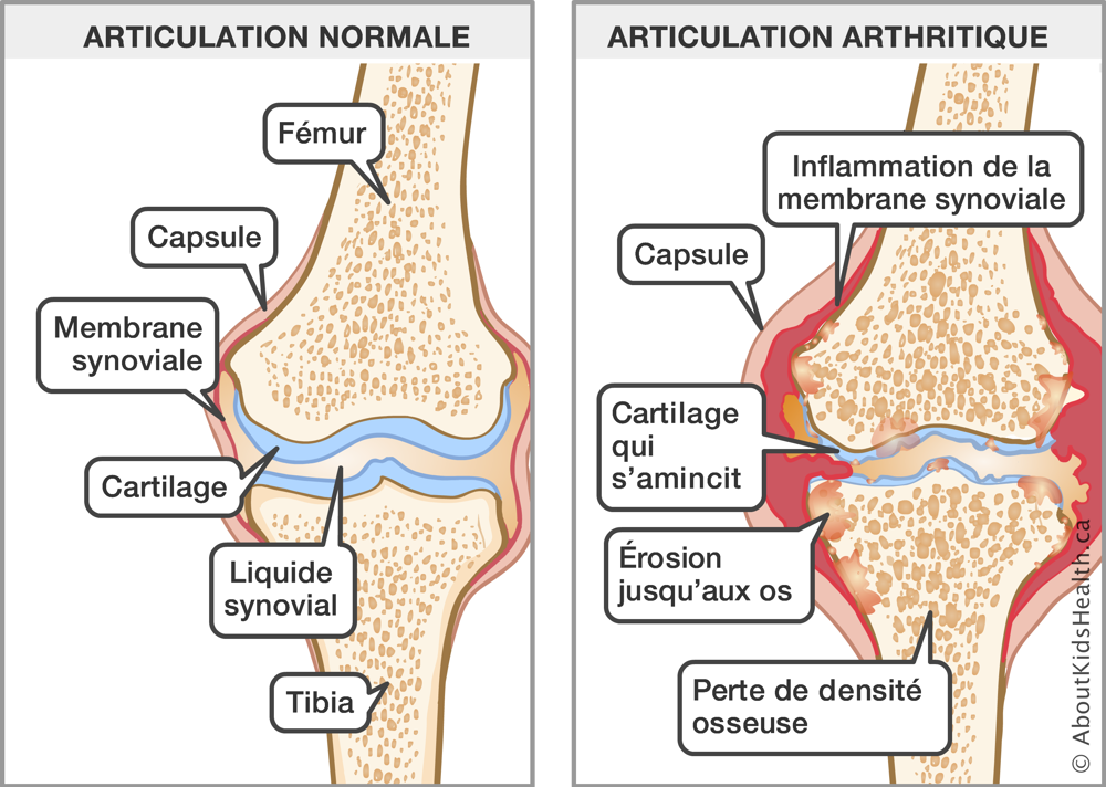 Articulation du genou normale et articulation du genou arthritique