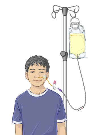 Adaptateur et pince &agrave; roulette sur une tubulure de perfusion pour relier le sac d&rsquo;alimentation &agrave; la sonde NG