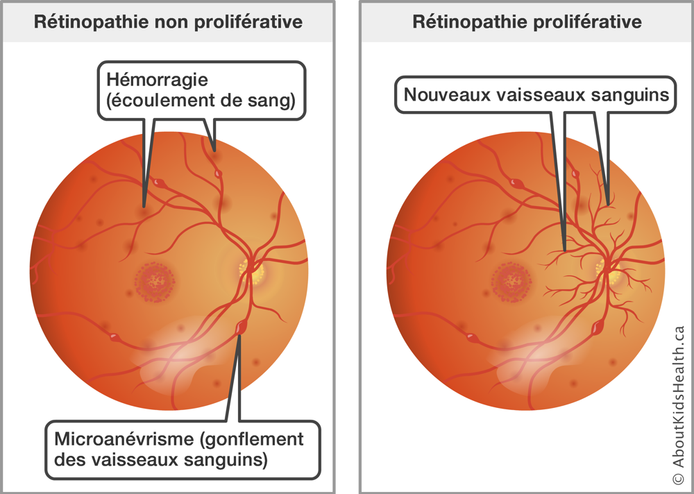 Parallèle entre une rétinopathie non proliférative et une rétinopathie proliférative sur la rétine de l’œil 