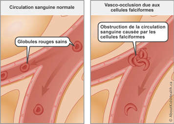 Normal blood flow with healthy red blood cells compared to blocked blood flow from sickled red blood cells