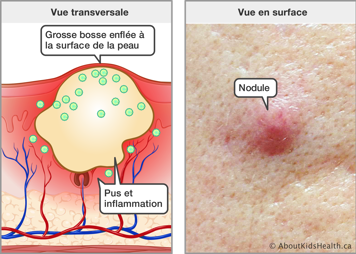 Vue transversale de la peau avec du pus et d’inflammation et une grosse bosse enflée, et la vue en surface d’une nodule