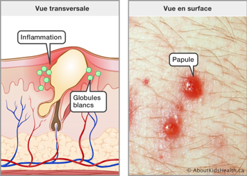 Vue transversale de la peau avec l’inflammation et les globules blancs autour du sébum et une vue en surface des papules