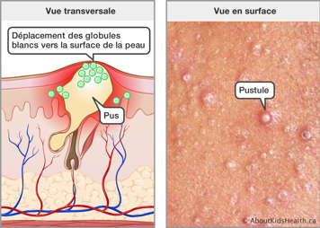 Vue transversale du pus sous le peau et le déplacement des globules blancs vers la surface, et la vue en surface des pustules