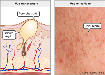 Vue transversale de la peau avec un sébum piégé et le pore obstrué et une vue en surface des points blancs