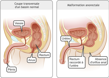 Coupes transversales d’un bassin normal mâle et d’un bassin avec l’absence d’orifice anal et le rectum raccordé à l’urètre