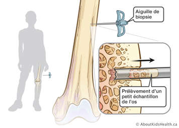 Aiguille de biopsie prélevant un petit échantillon d’os