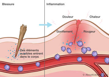 Une esquille dans la peau causant de douleur, chaleur, rougeur et gonflement