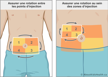 Assurer une rotation entre les quatre points d’injection sur l’abdomen et puis une rotation au sein des zones d’injection