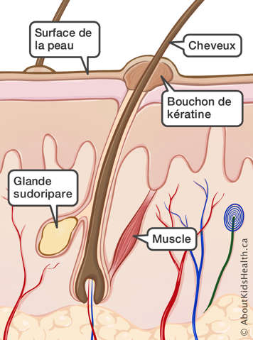 Coupe transversal de la peau touchée par la kératose pilaire