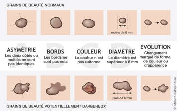 Illustration des grains de beauté normaux et des grains de beauté potentiellement dangereux selon la règle de l’ABCDE