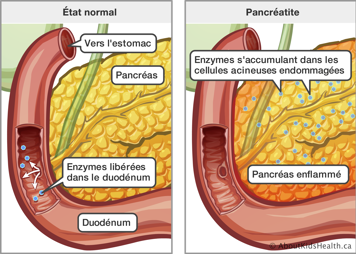 État normal du pancréas comparé à un pancréas enflammé avec accumulation des enzymes dans les cellules acineuses endommagées