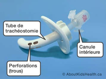 Les parties d’un tube de trachéostomie avec perforations