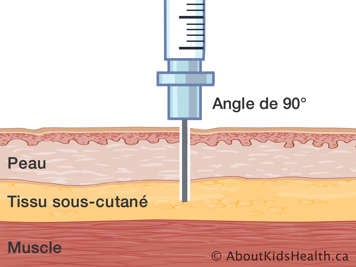 Le peau, le tissu sous-cutané et le muscle avec une aiguille insérée à un angle de quatre-vingt-dix degrés