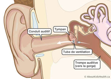 Tube de ventilation dans le tympan pour permettre l’air de passer par la trompe auditive au conduit auditif
