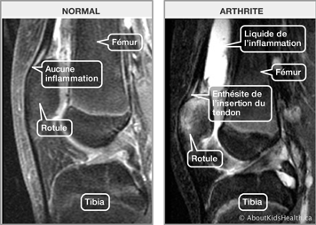 IRM d’une articulation du genou normale et IRM d’une articulation arthritique d’un genou