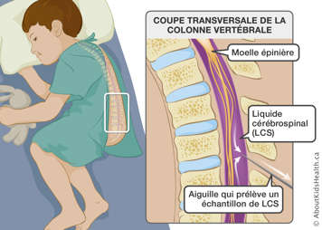 Coupe transversal de la colonne vertébrale avec une aiguille insérée pour prélever un échantillon de liquide cérébrospinal