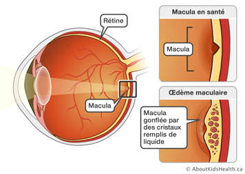 Inside view of the eyeball showing a side by side comparison of a healthy macula versus a macula showing macular edema