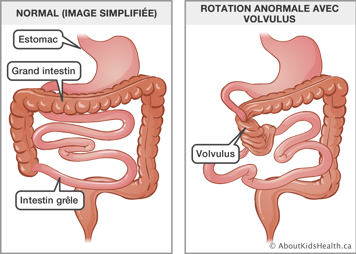 Image simplifiée d’un estomac, grand instestin et intestin grêle normaux, et illustration de rotation anormale avec volvulus