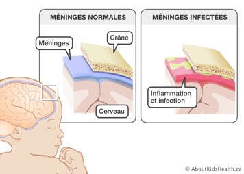 Gros plans des méninges normales entre le crâne et le cerveau et des méninges infectées et inflammées