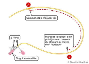 Marques du point de commencement et du point juste en dessous du sternum sur une sonde nasogastrique