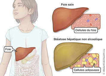 Emplacement du foie avec un parall&egrave;le entre un foie et des cellules du foie sains et un foie et des cellules endommag&eacute;s par l&rsquo;accumulation de graisses