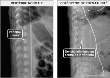 Rayon-x des vertèbres normaux et rayon-x des vertèbres d’un patient atteint d’ostéopénie de la prémutarité