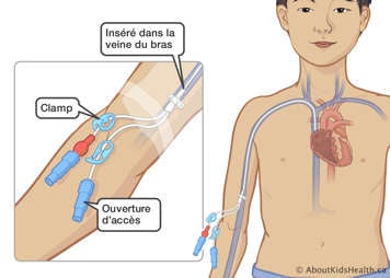 Un cathéter inséré dans la veine du bras d’un enfant avec un clamp et une ouverture d’accès à l’extérieur