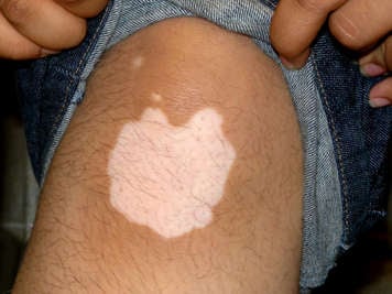 Le vitiligo sur un genou de peau foncée