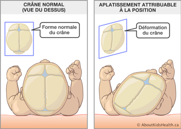 Vue de dessus d'une forme normale du crâne et d'une déformation du crâne à cause de l'aplatissement attribuable à la position