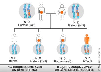 Graphique de la distribution des chromosomes d’un homme et d’une femme, chacun avec un chromosome avec un gène de drépanocyte